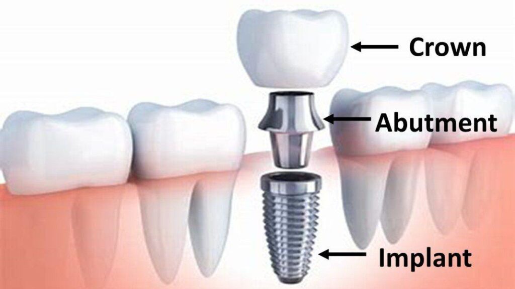 Implant parts